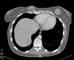 Metastatic Melanoma Metastatic to Subcutaneous Tissues and Adrenal Gland - CTisus CT Scan