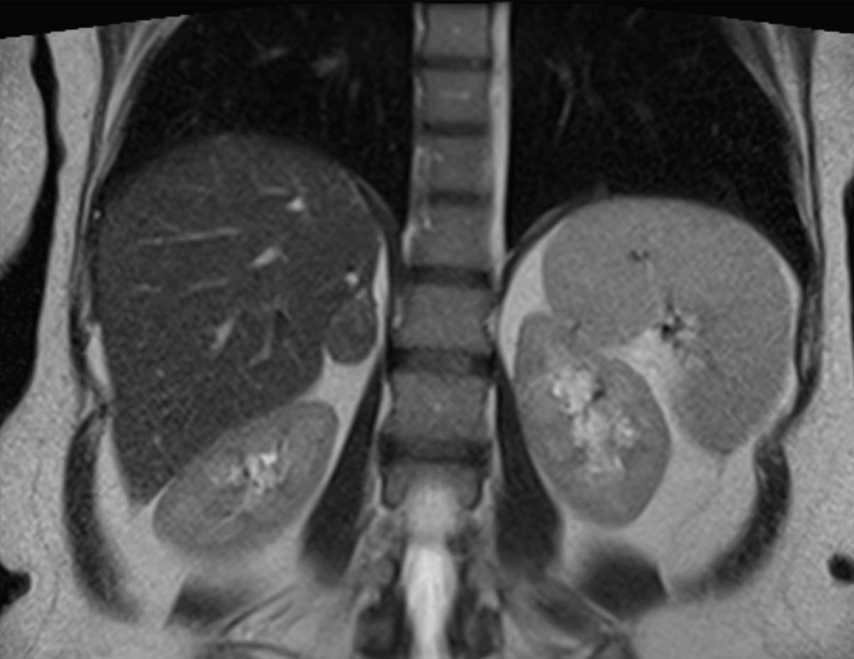 Bilateral Bartholin Gland Cysts. - Body MR Case Studies - CTisus CT ...