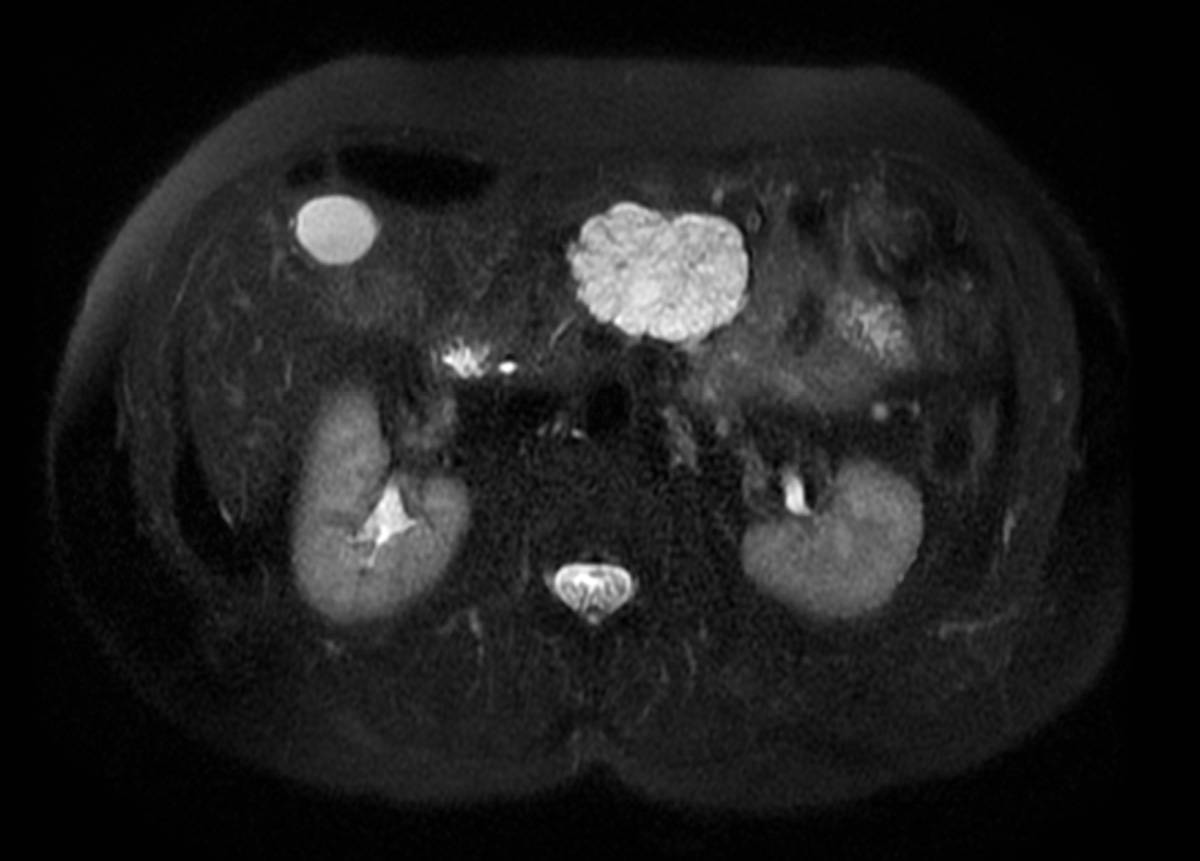 Serous Cystadenoma. - CTisus CT Scan