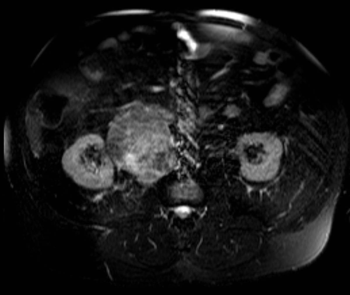 Retroperitoneal Leiomyosarcoma. - CTisus CT Scan