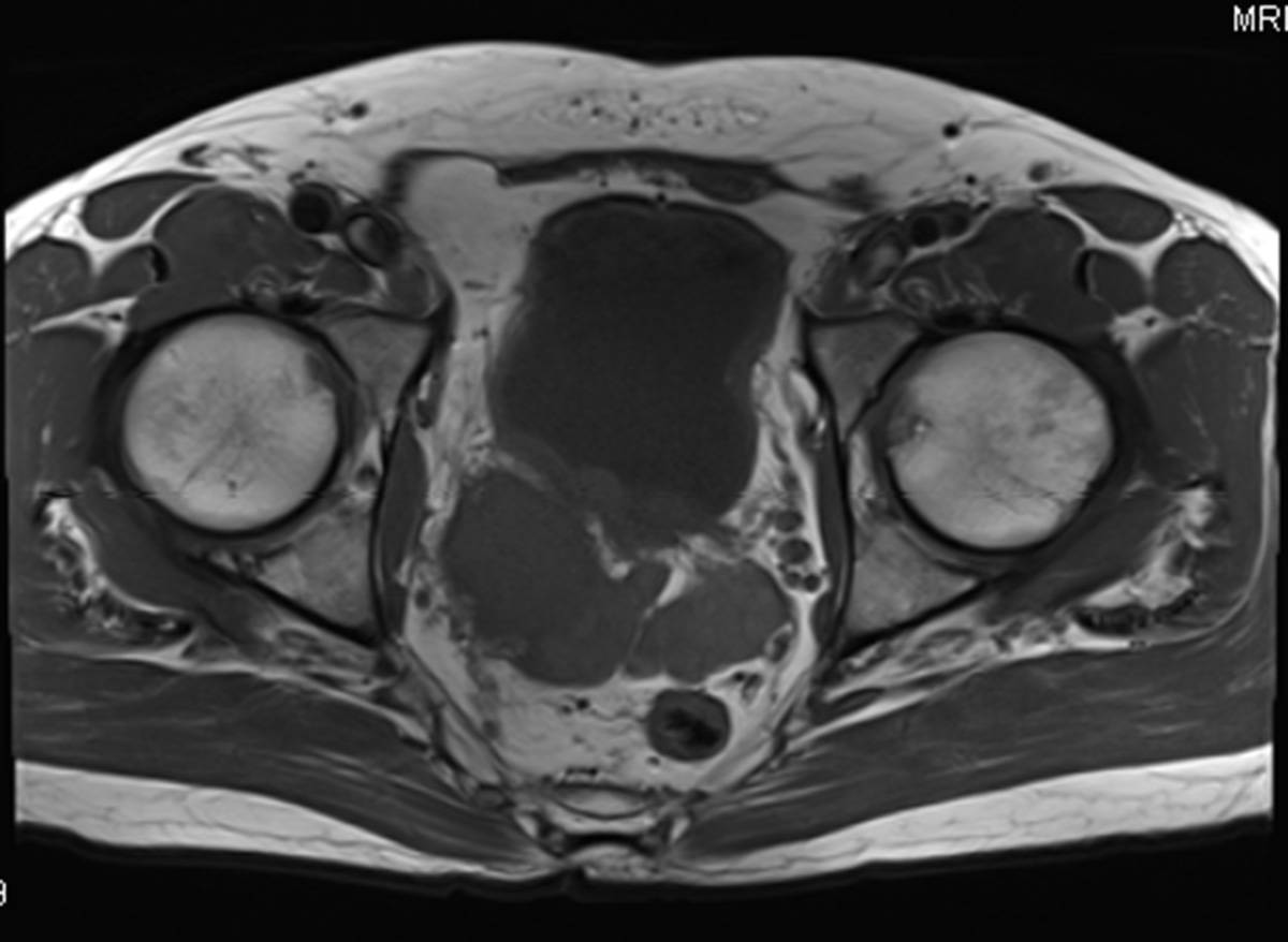 Transitional Cell Carcinoma within a Bladder Diverticulum. - CTisus CT Scan