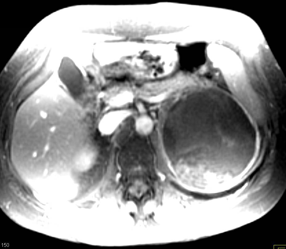 MEST on MR of the Kidneys - CTisus CT Scan