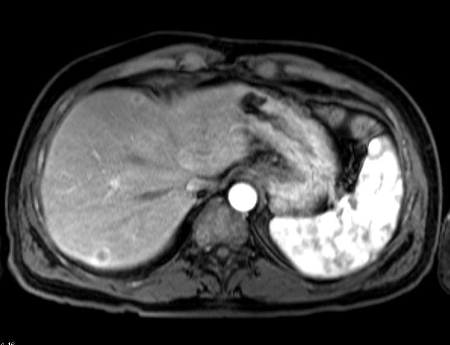 Neuroendocrine Tumor with Liver Metastases - CTisus CT Scan