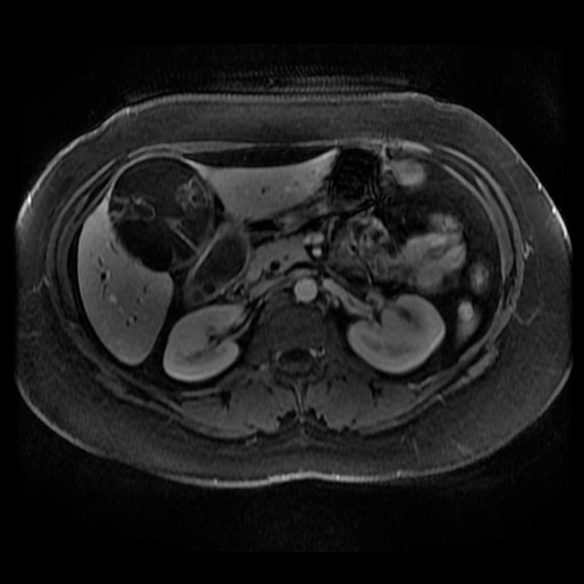 Biliary cystadenoma - CTisus CT Scan