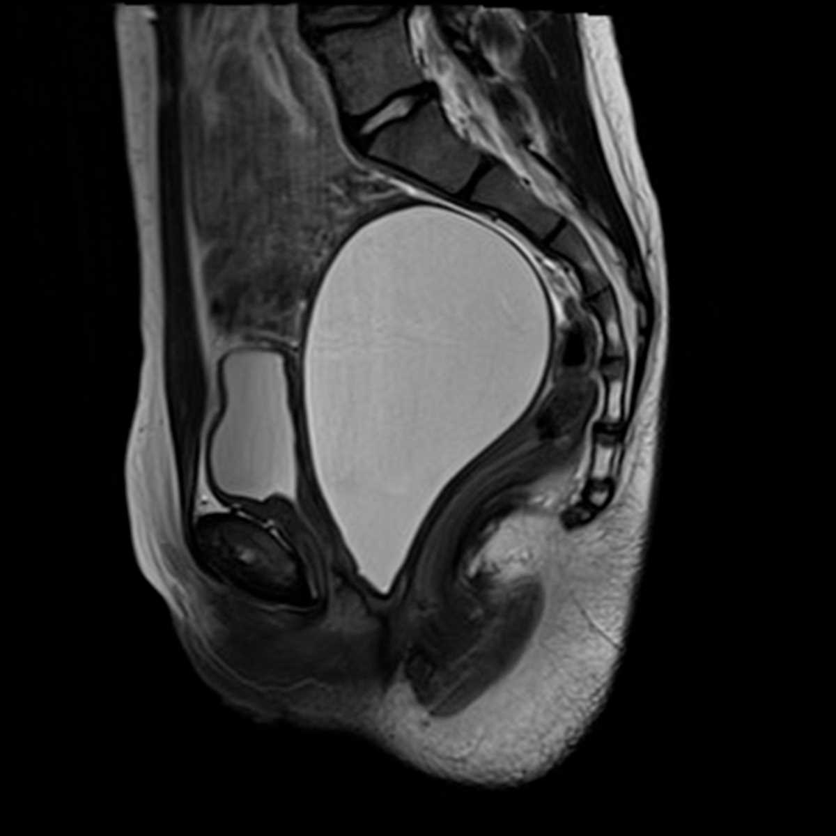 Hematometrocolpos - CTisus CT Scan