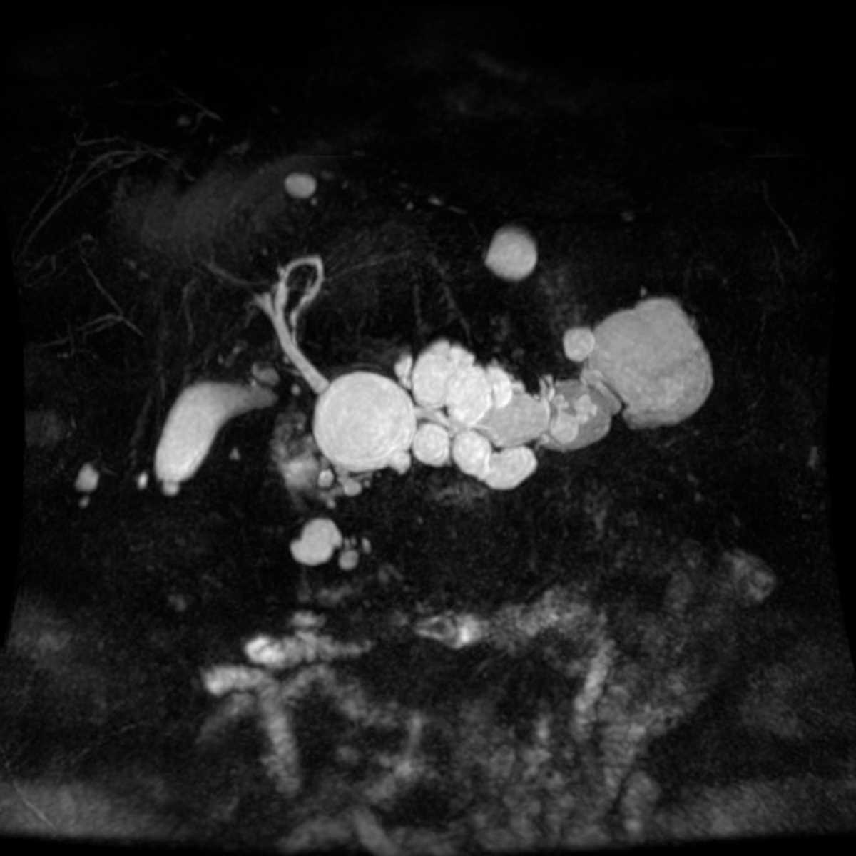 Multifocal intraductal mucinous neoplasms (IPMN) - CTisus CT Scan