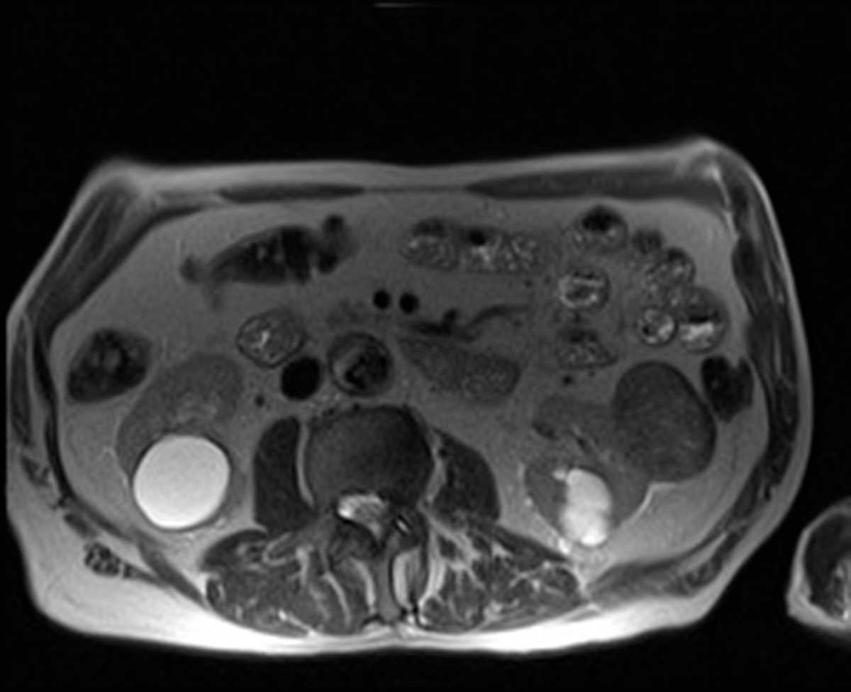 Papillary renal cell carcinoma - CTisus CT Scan