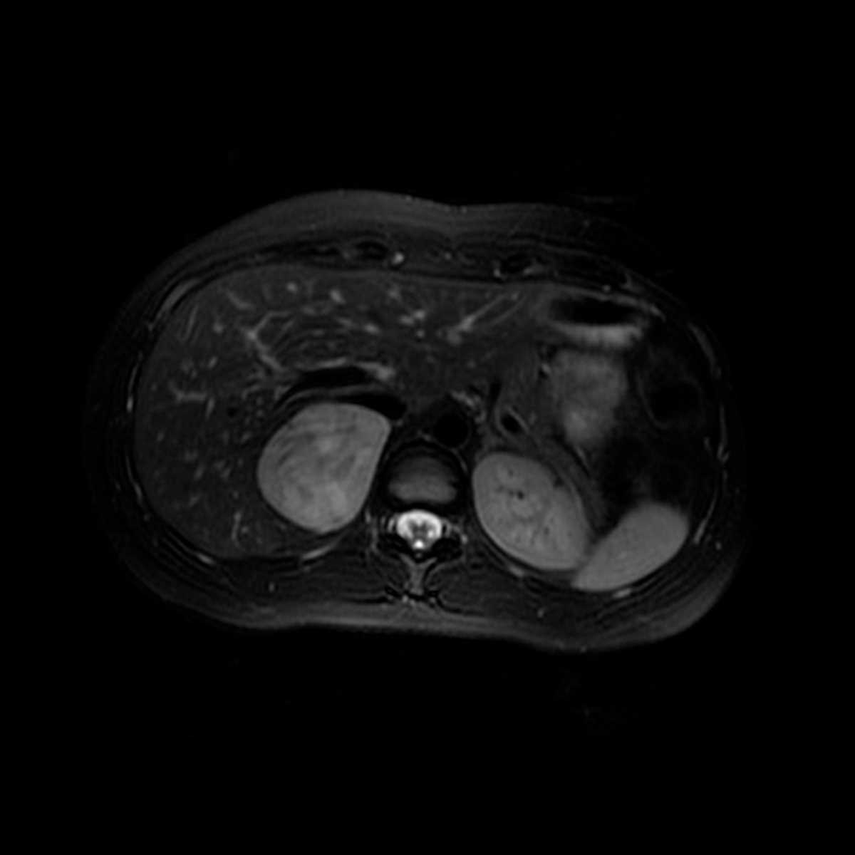 Adrenal Pheochromocytoma - CTisus CT Scan