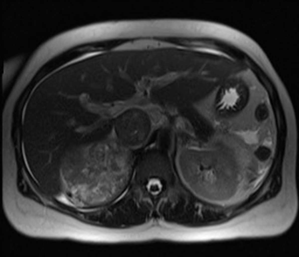 Renal Cell Carcinoma (RCC) with vascular invasion - CTisus CT Scan