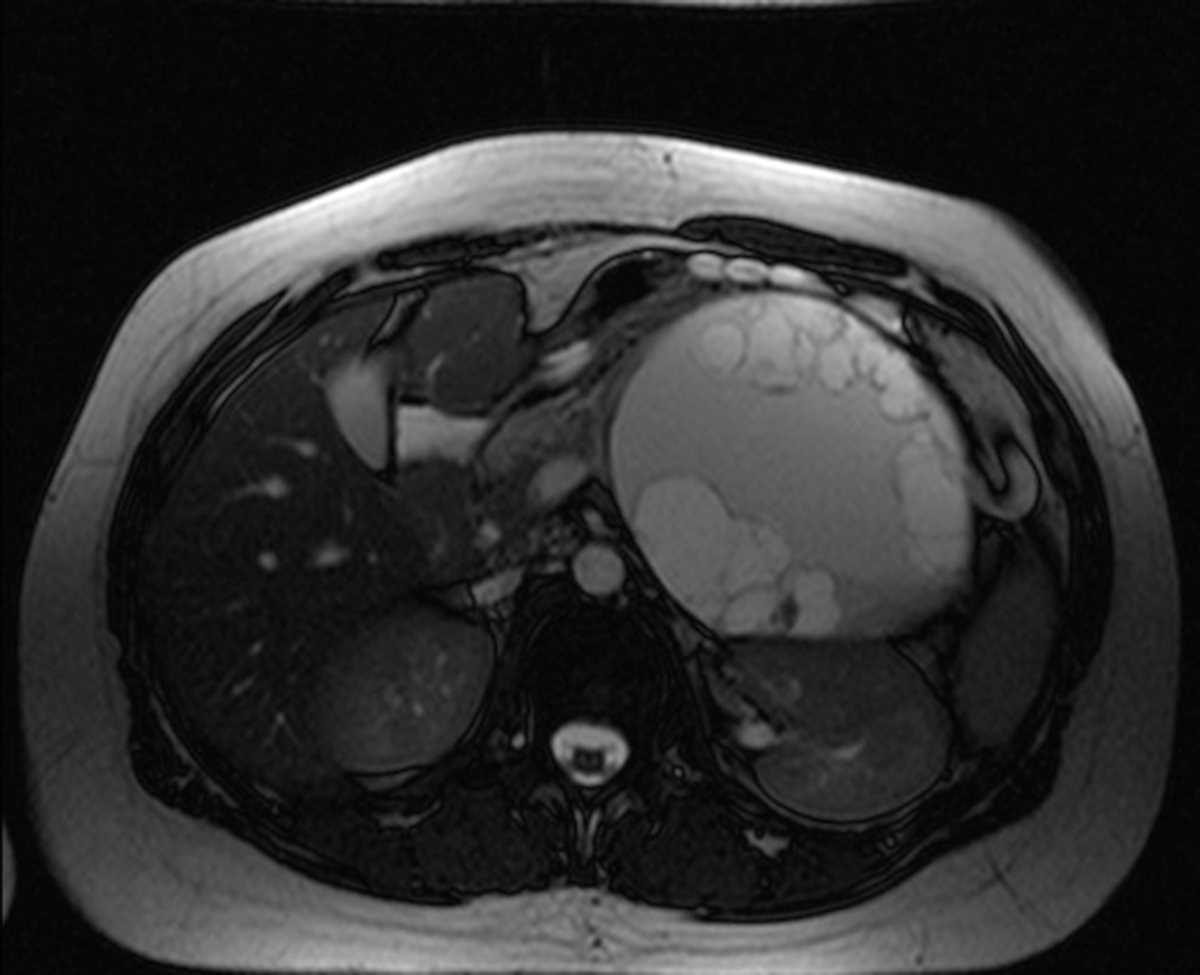 Large mucinous cystic neoplasm (MCN) of the pancreas - CTisus CT Scan