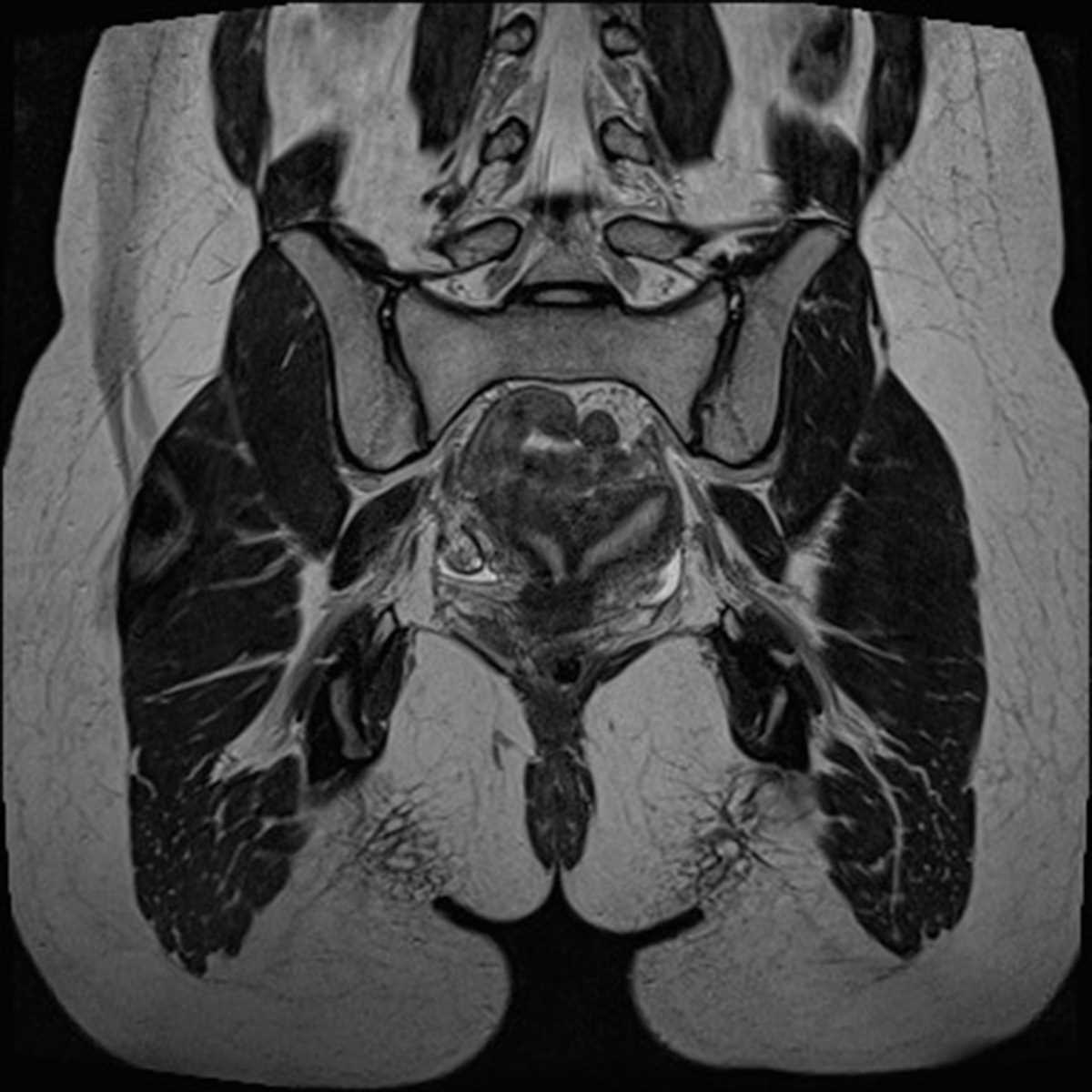 Uterine didelphys - CTisus CT Scan