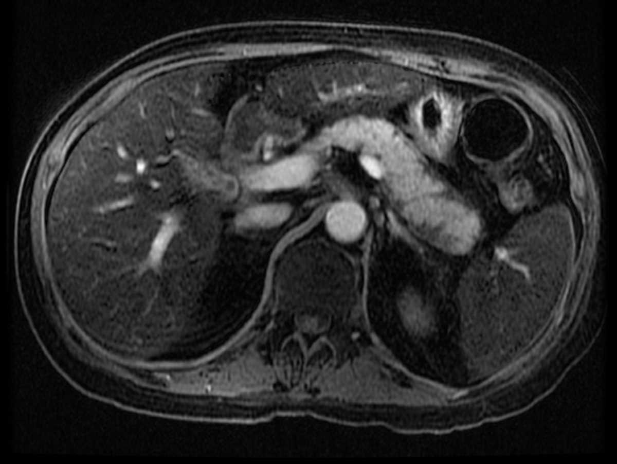 Autoimmune pancreatitis - CTisus CT Scan
