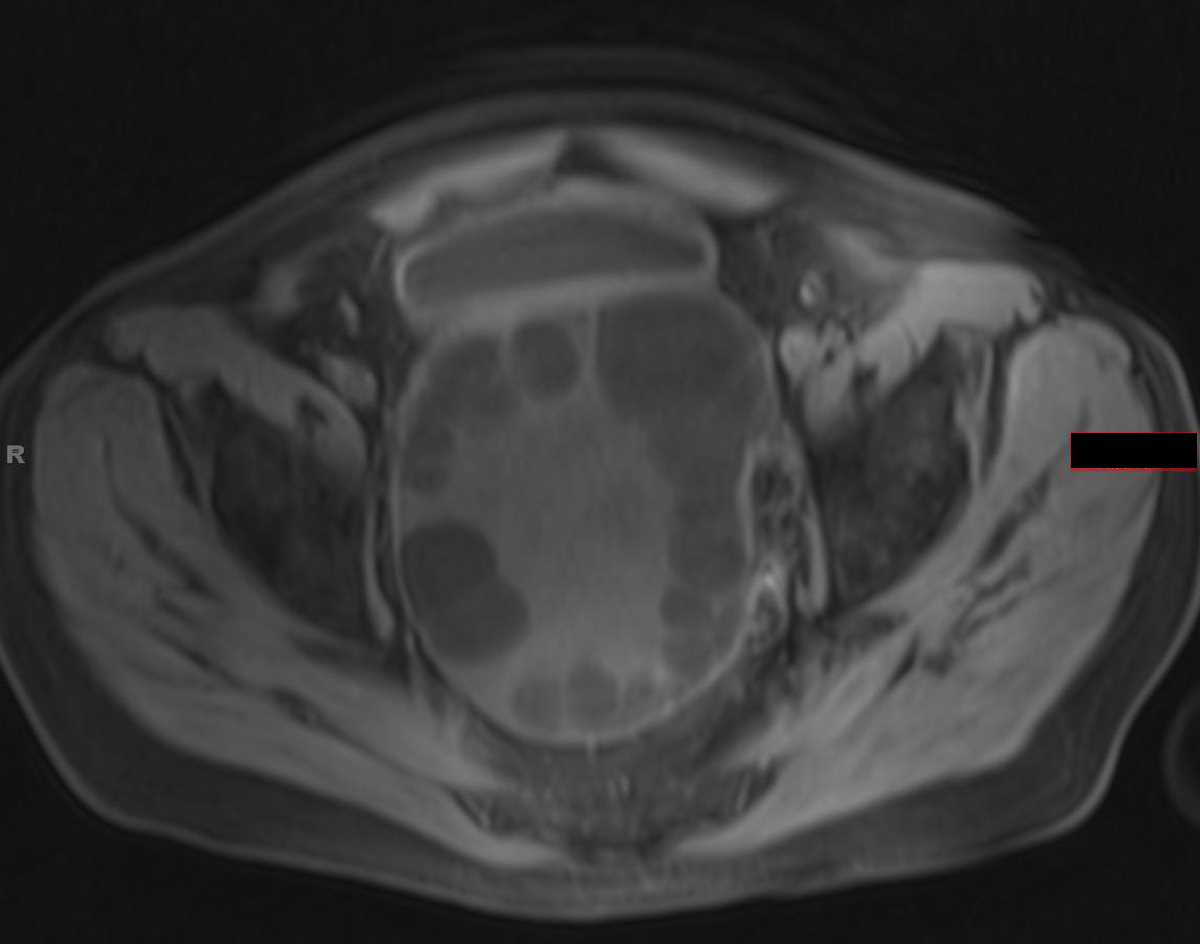 Echinococcal cysts - CTisus CT Scan
