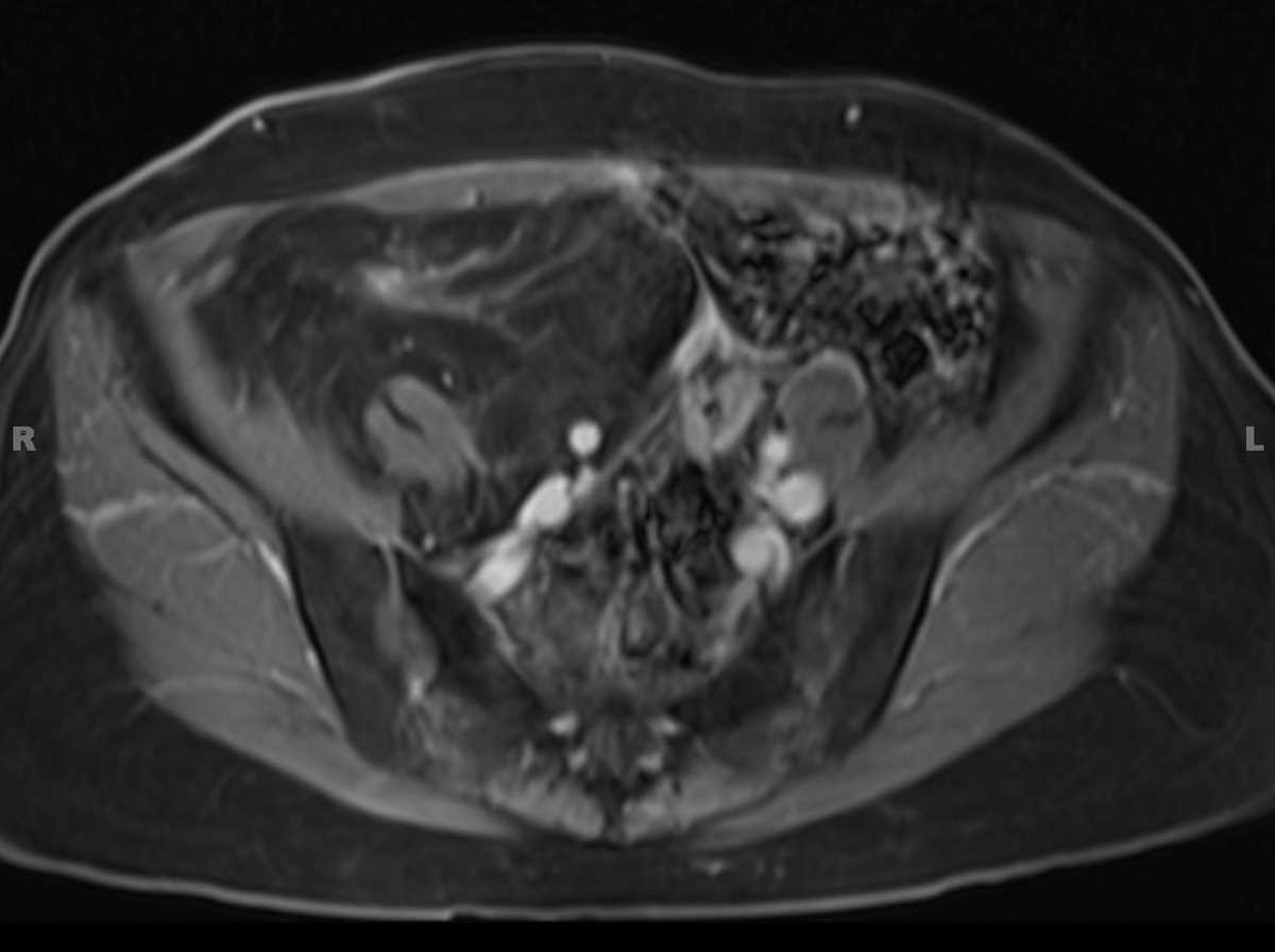 Retroperitoneal liposarcoma - CTisus CT Scan