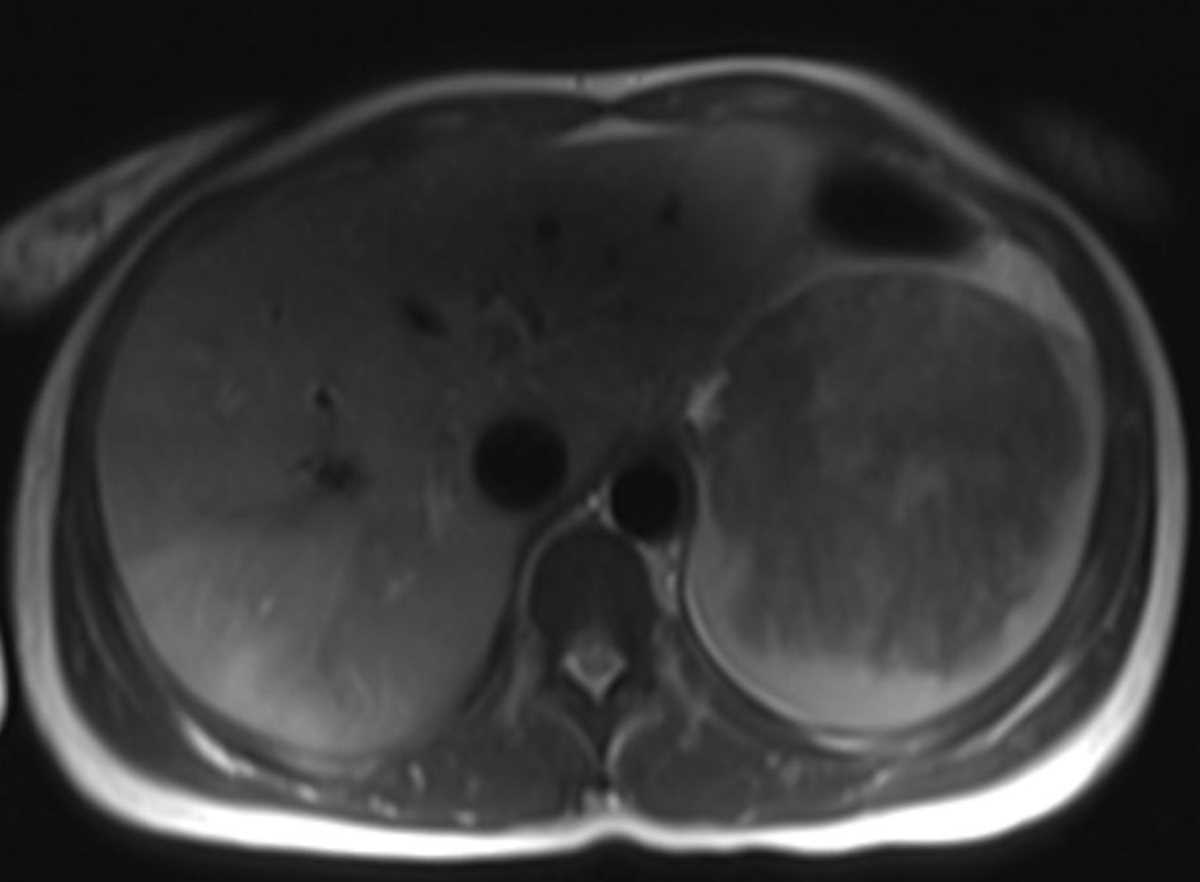 Sclerosing angiomatoid nodular transformation (SANT) of the spleen - CTisus CT Scan