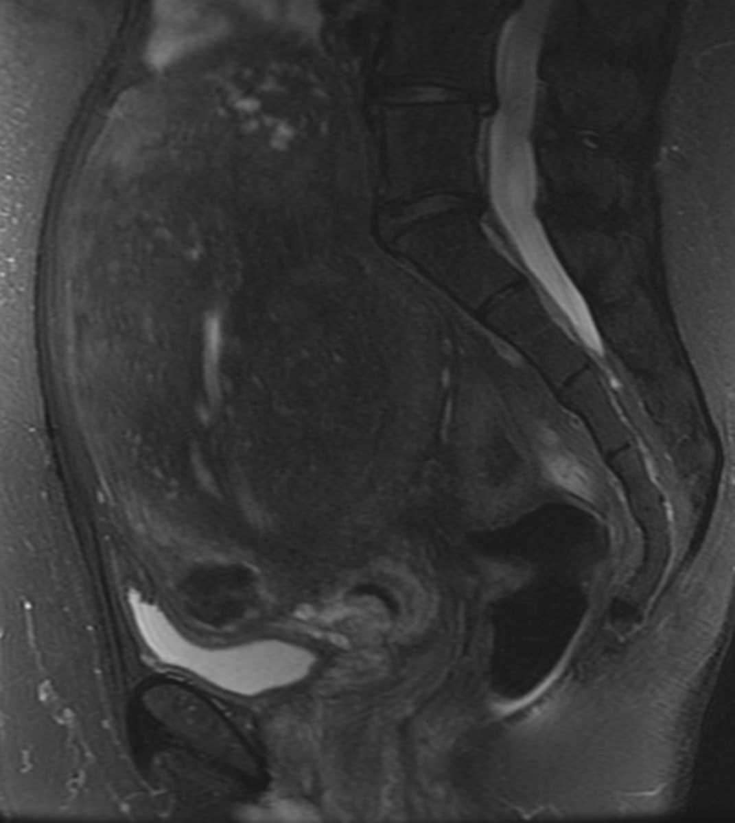 Uterine Adenomyosis - CTisus CT Scan