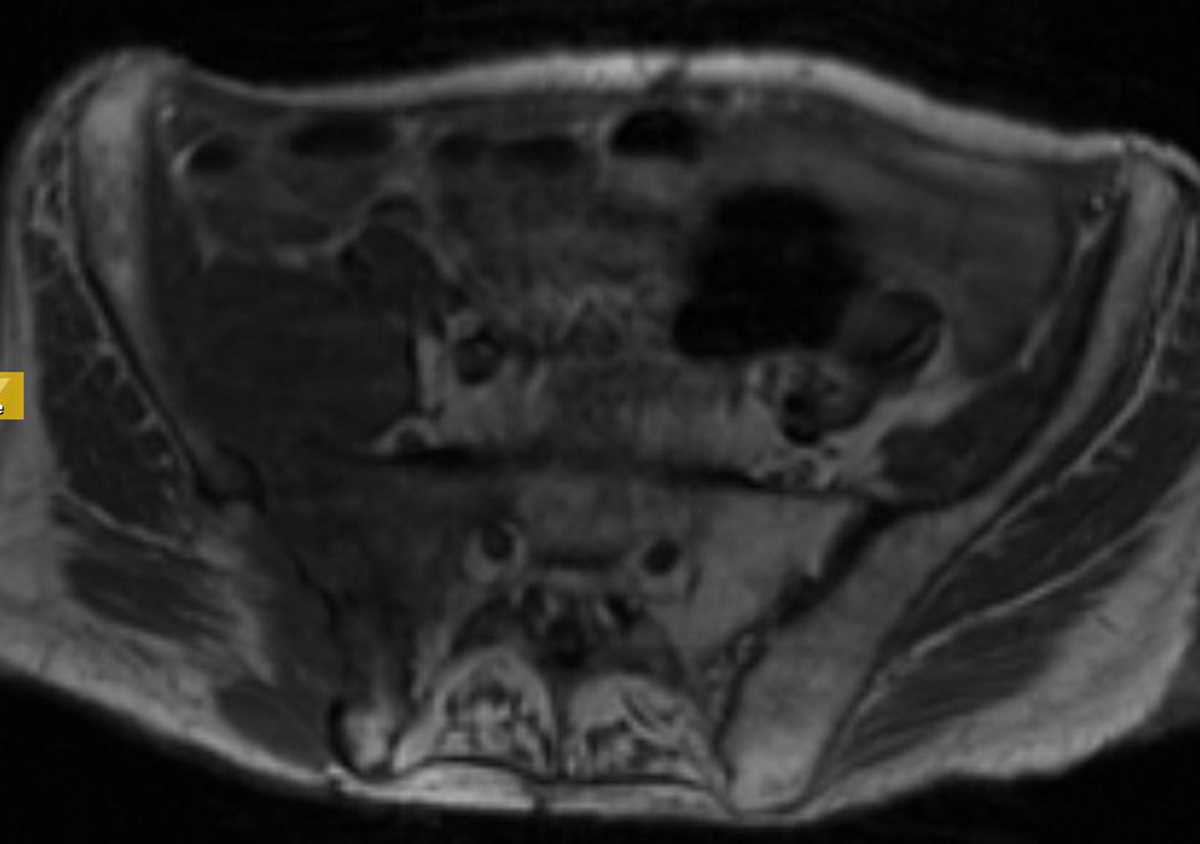 Unilateral Sacroiliitis from Tuberculosis - CTisus CT Scan