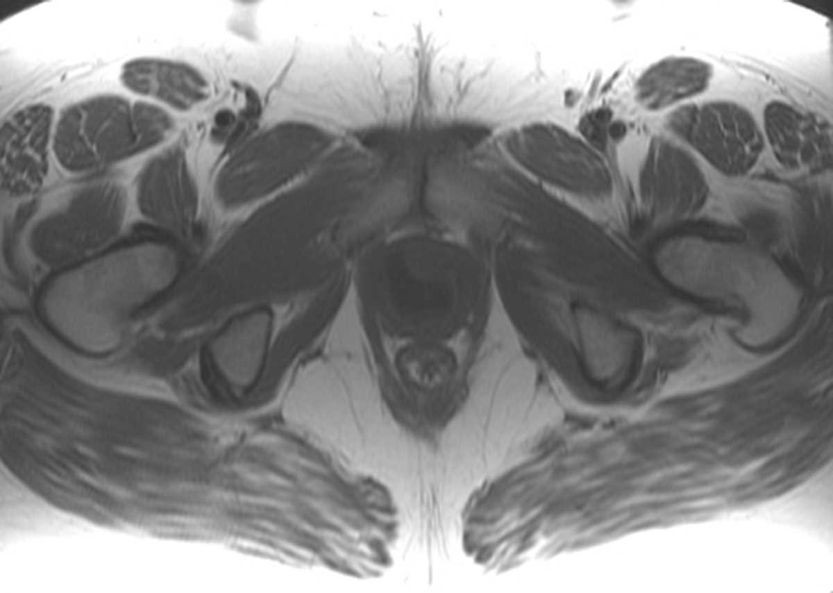 Urethral Diverticulum - CTisus CT Scan
