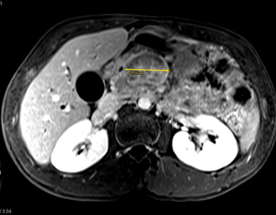 Pancreatic cancer and IPMM - CTisus CT Scan