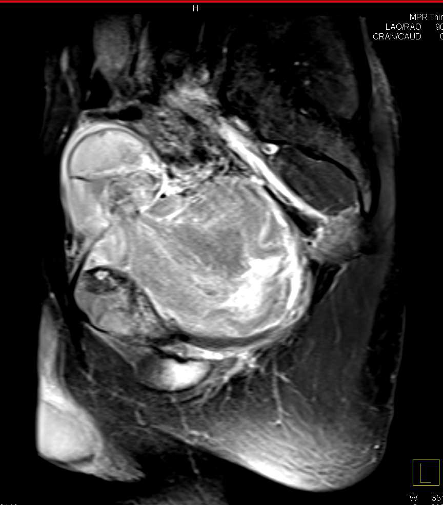 Pelvic Ewing Sarcoma - CTisus CT Scan