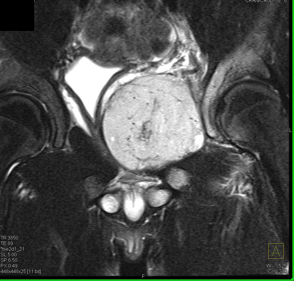 Pelvic Ewing Sarcoma - CTisus CT Scan