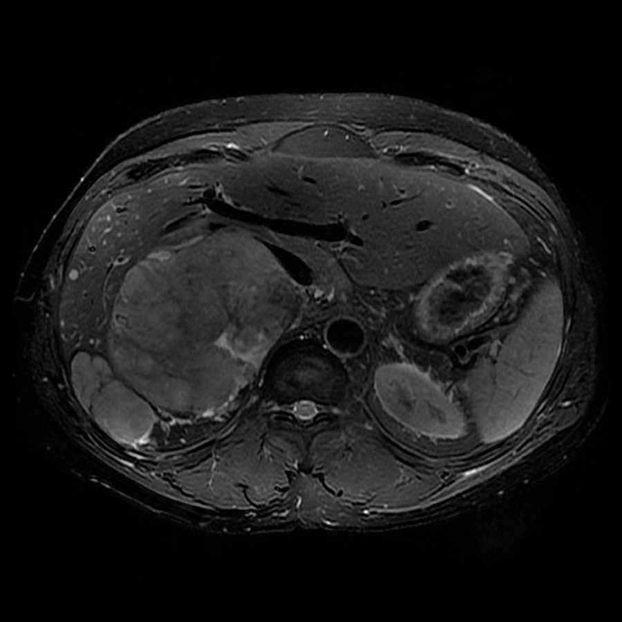 Adrenocortical Carcinoma - CTisus CT Scan