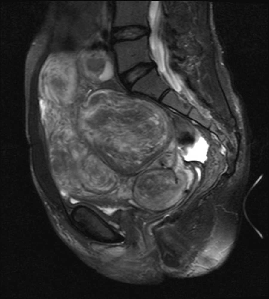 Benign metastasizing leiomyomas - CTisus CT Scan