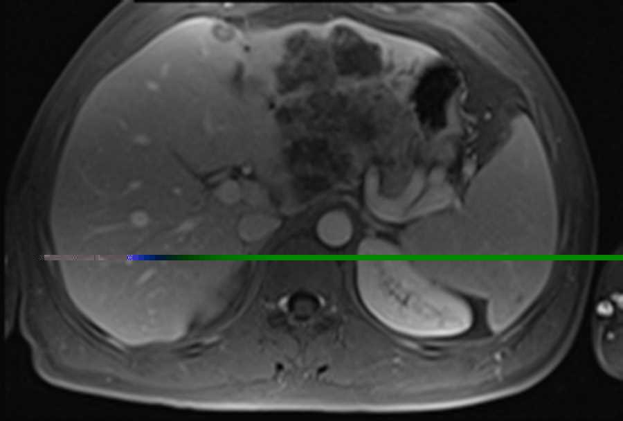 Cholangiocarcinoma - CTisus CT Scan