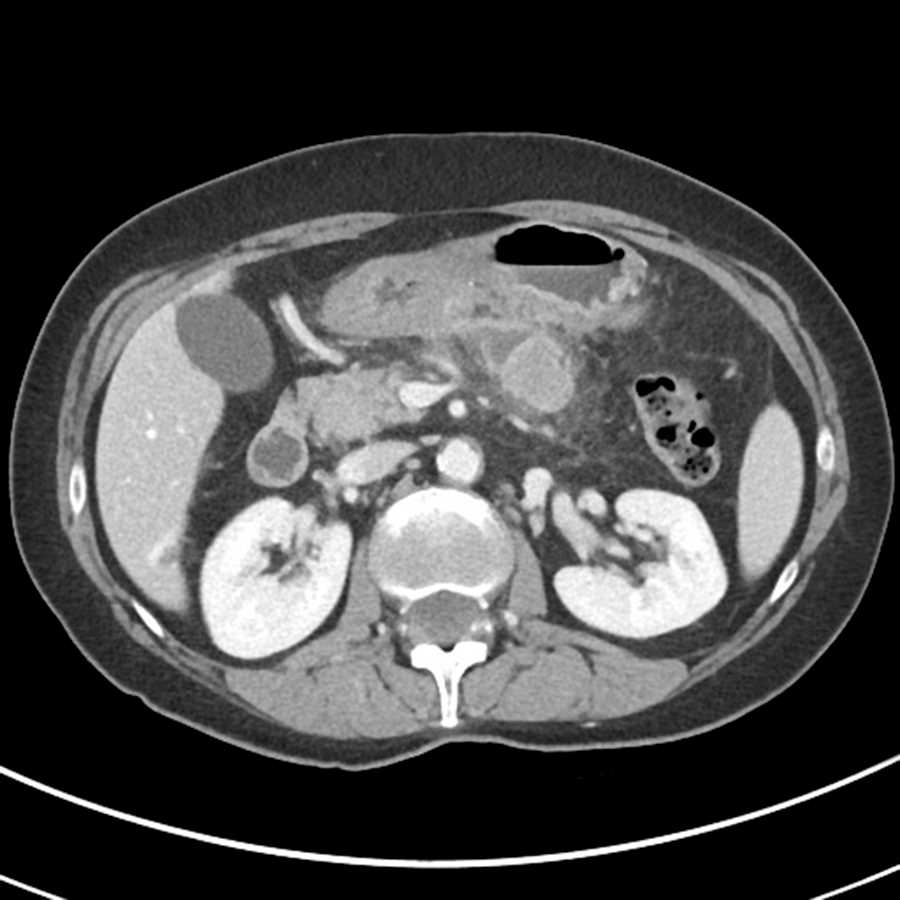 Duodenal desmoid tumor - CTisus CT Scan