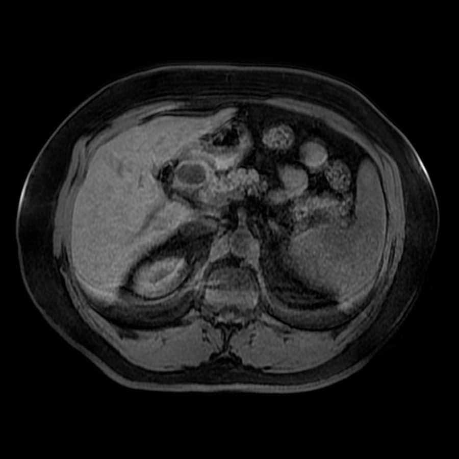 Heterotopic pancreas - CTisus CT Scan