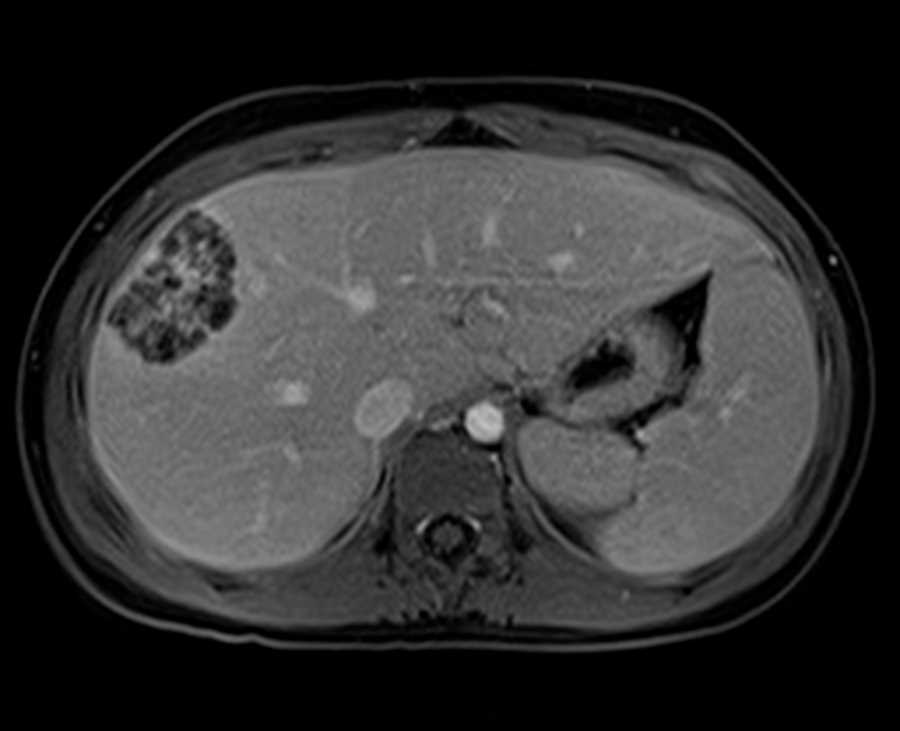 Liver abscess - CTisus CT Scan