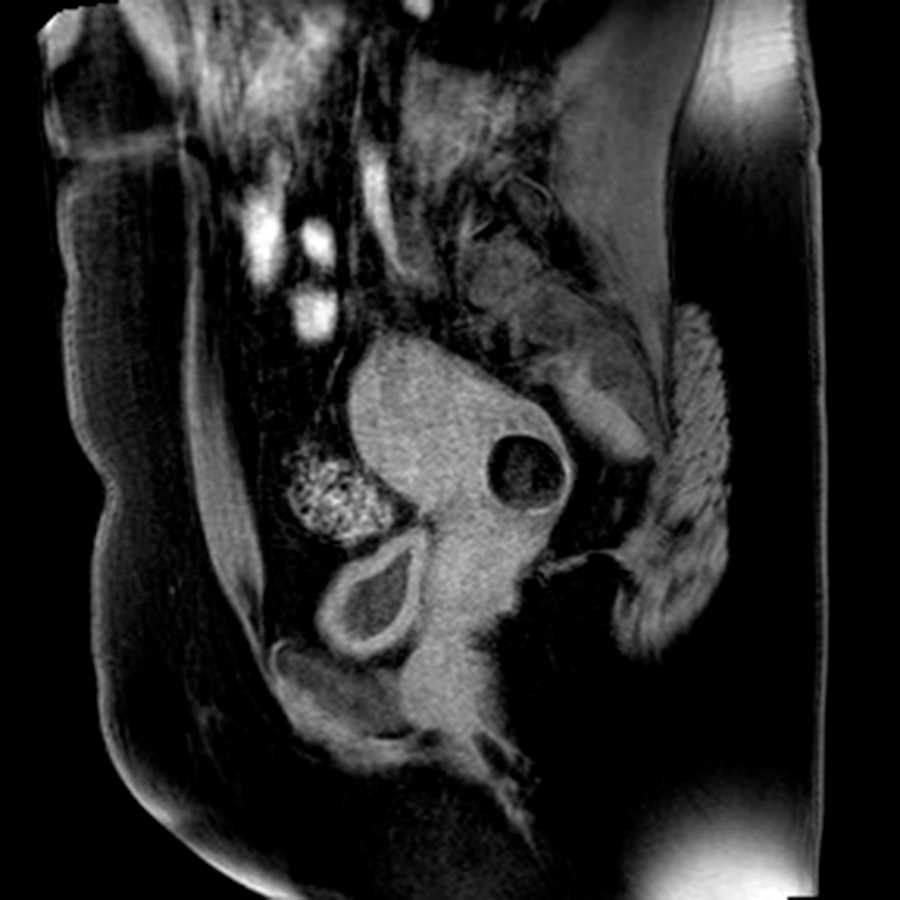 Ovarian dermoid - CTisus CT Scan