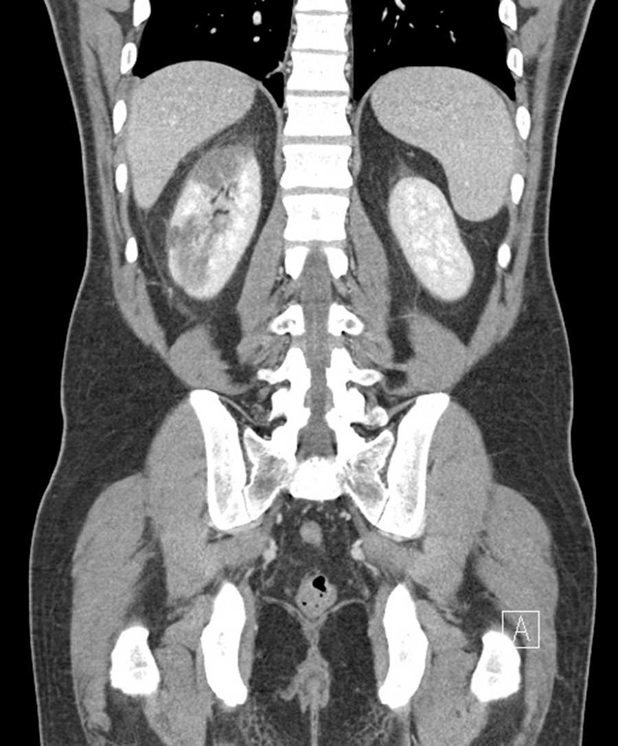 Renal infarcts - CTisus CT Scan