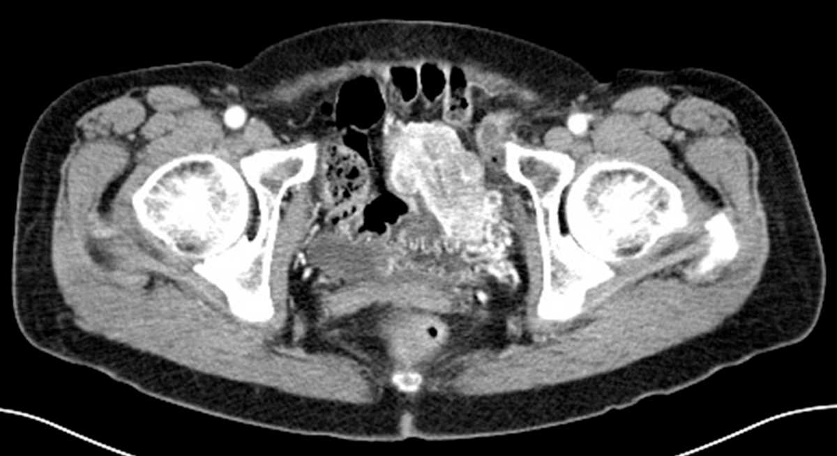 Bladder pheochromocytoma - CTisus CT Scan