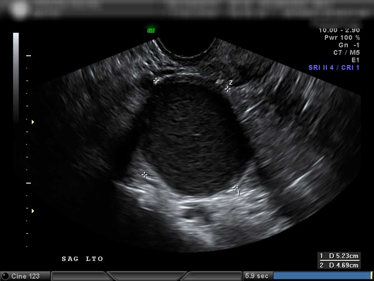 Endometrioma - CTisus CT Scan