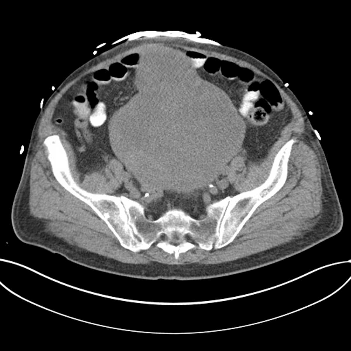 Gastrointestinal stromal tumor arising from the urachus - CTisus CT Scan