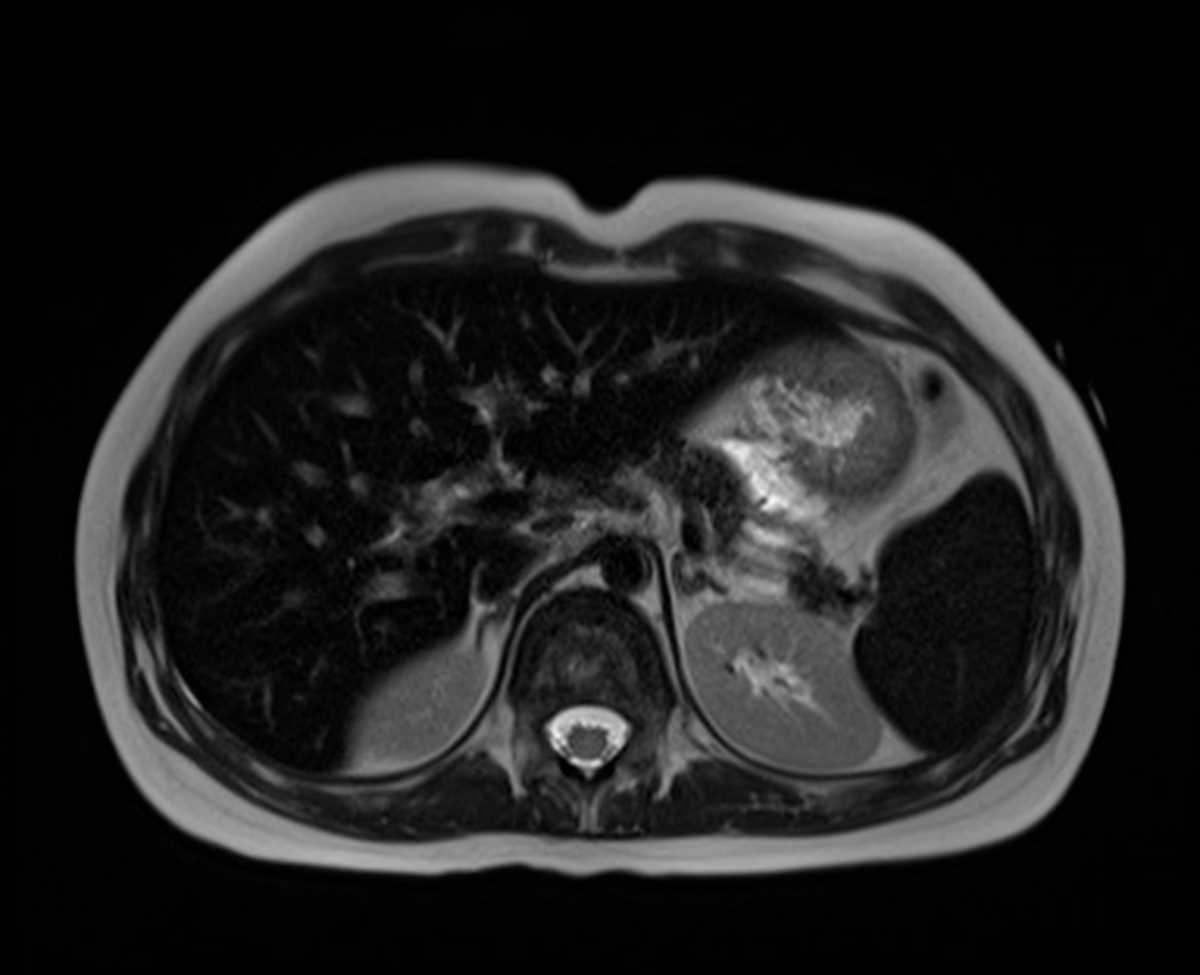 Hemosiderosis - CTisus CT Scan