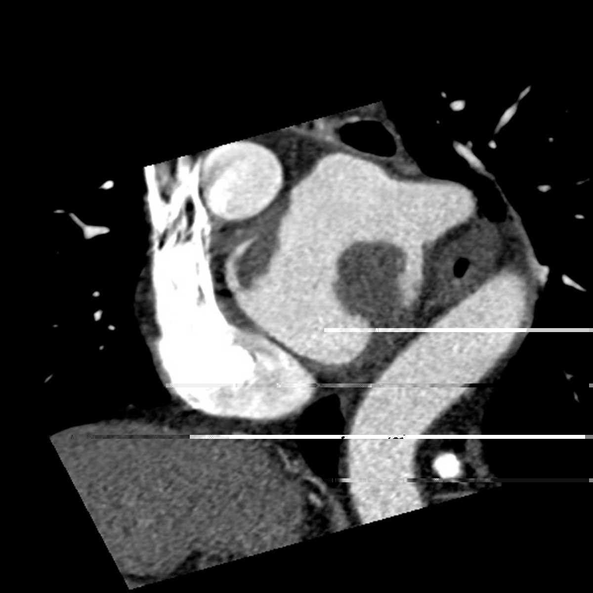 Left atrial thrombus - CTisus CT Scan