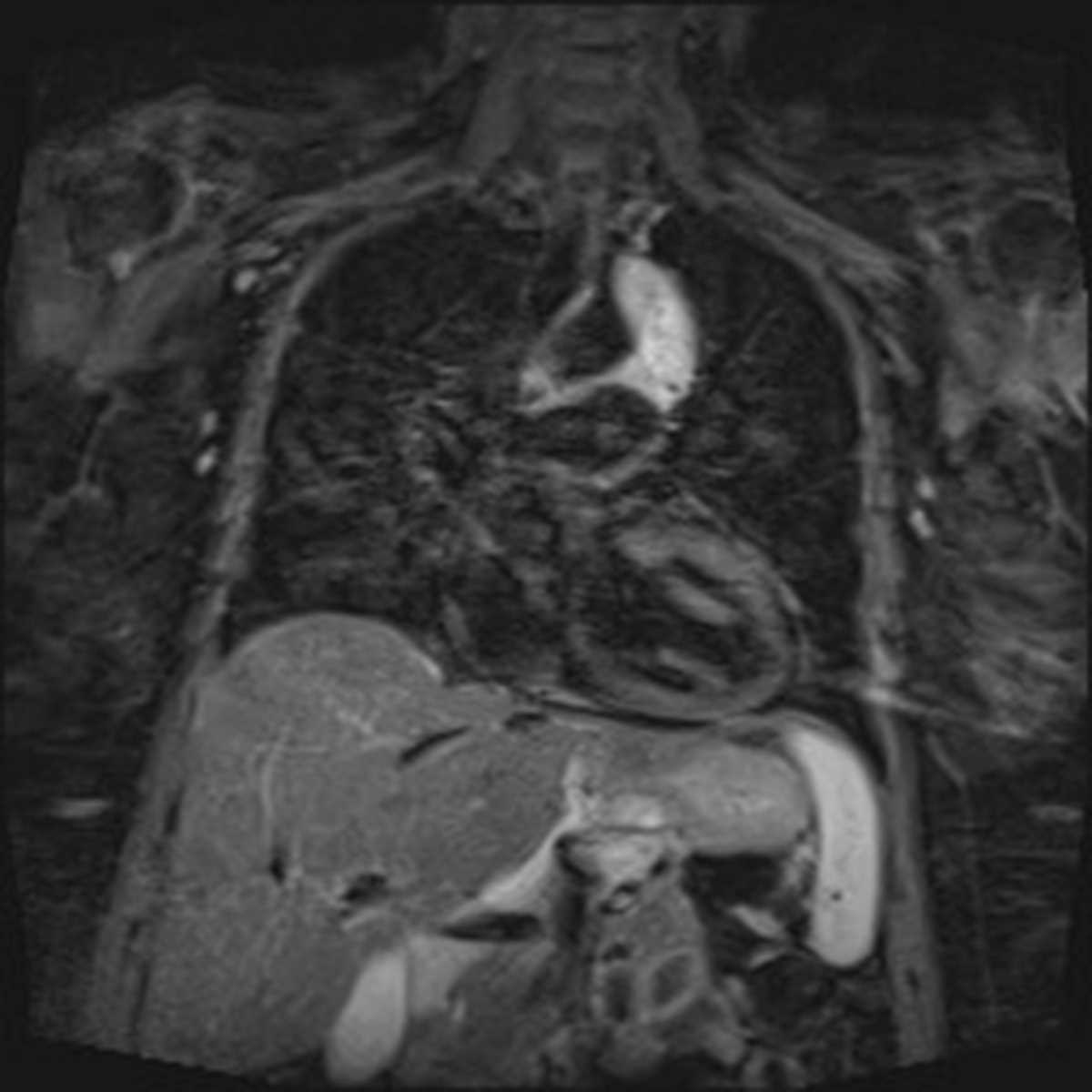 Mediastinal paraganglioma - CTisus CT Scan