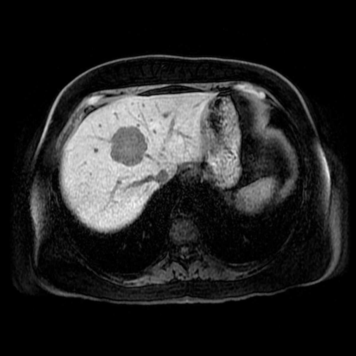 Primary adenoid cystic carcinoma of the liver - CTisus CT Scan