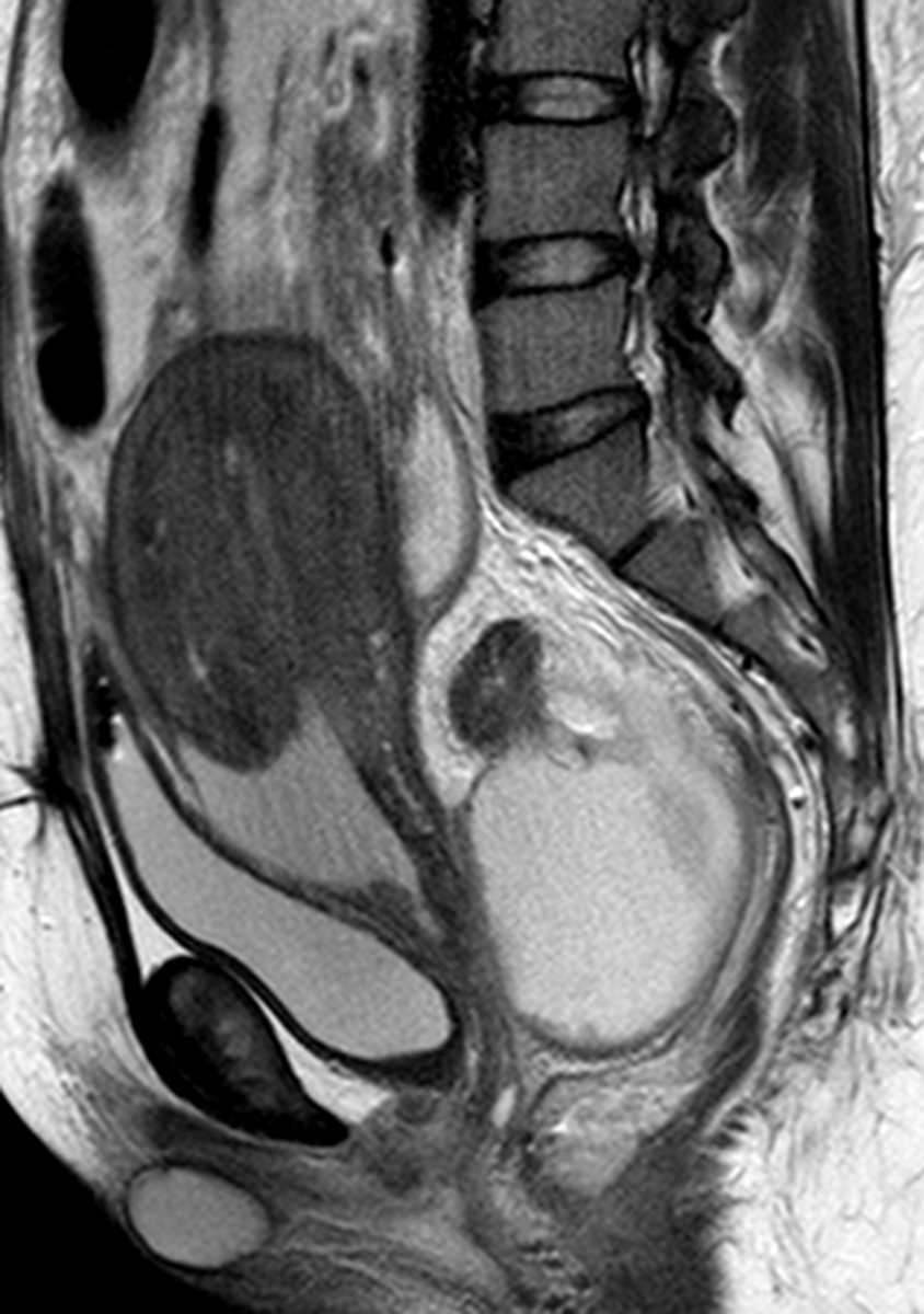 Uterine rupture - CTisus CT Scan