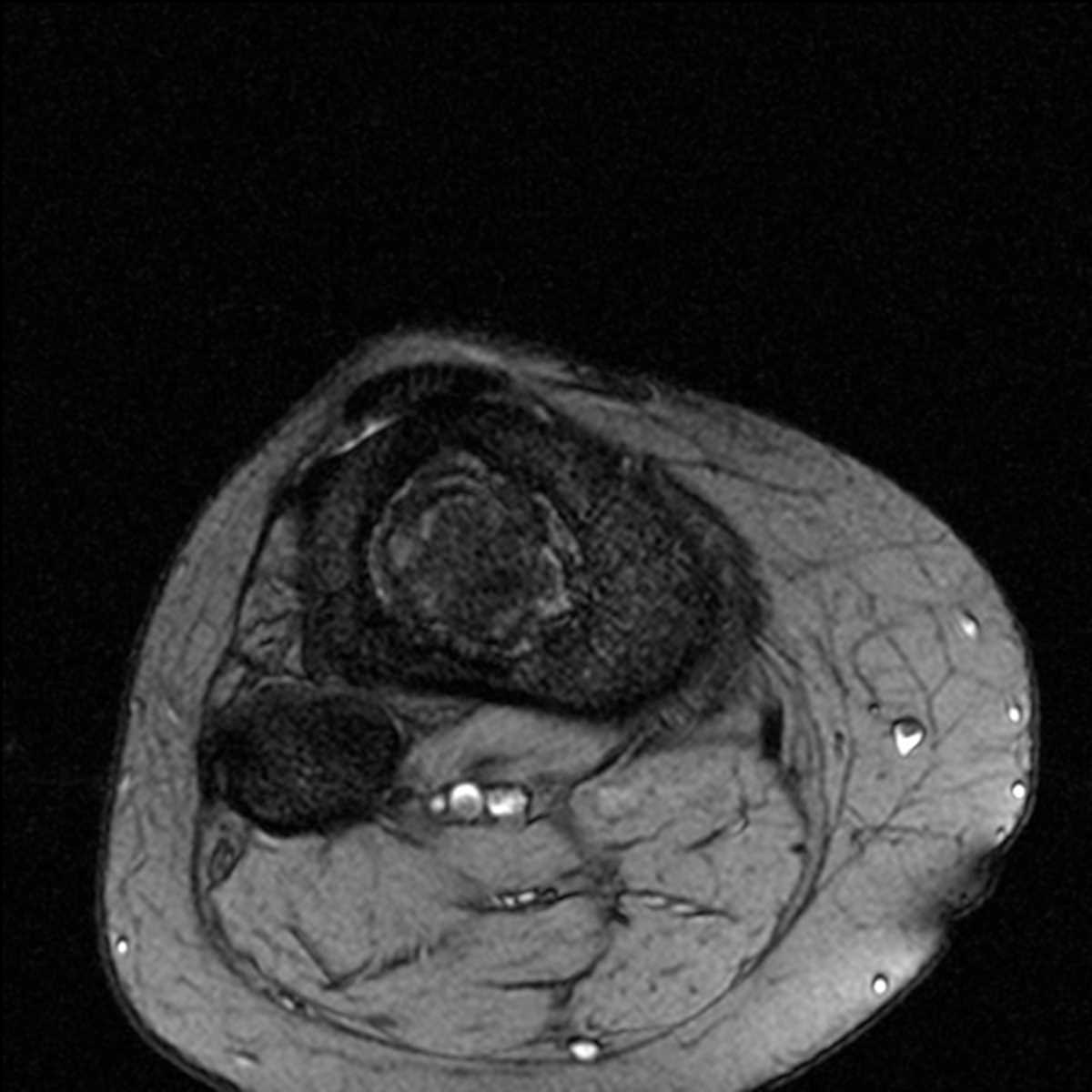 Bone infarct - CTisus CT Scan