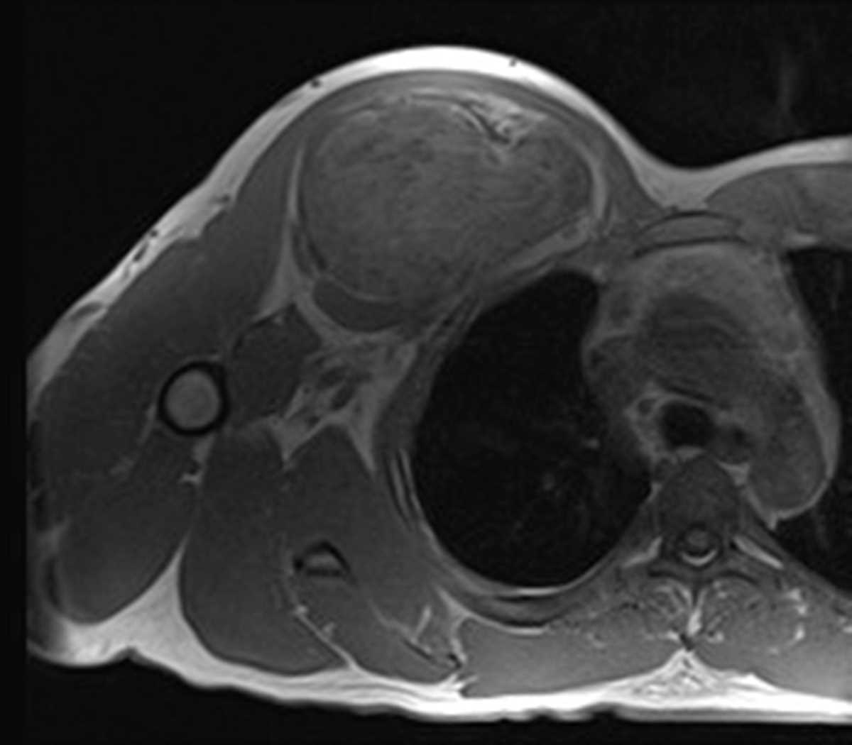 Chest wall hibernoma - CTisus CT Scan