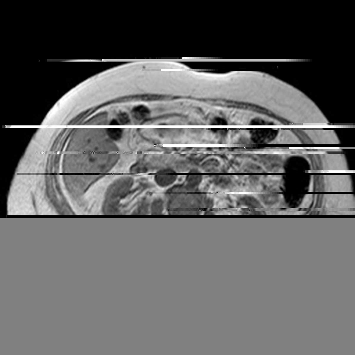 Fatty infiltration of the pancreatic head - CTisus CT Scan