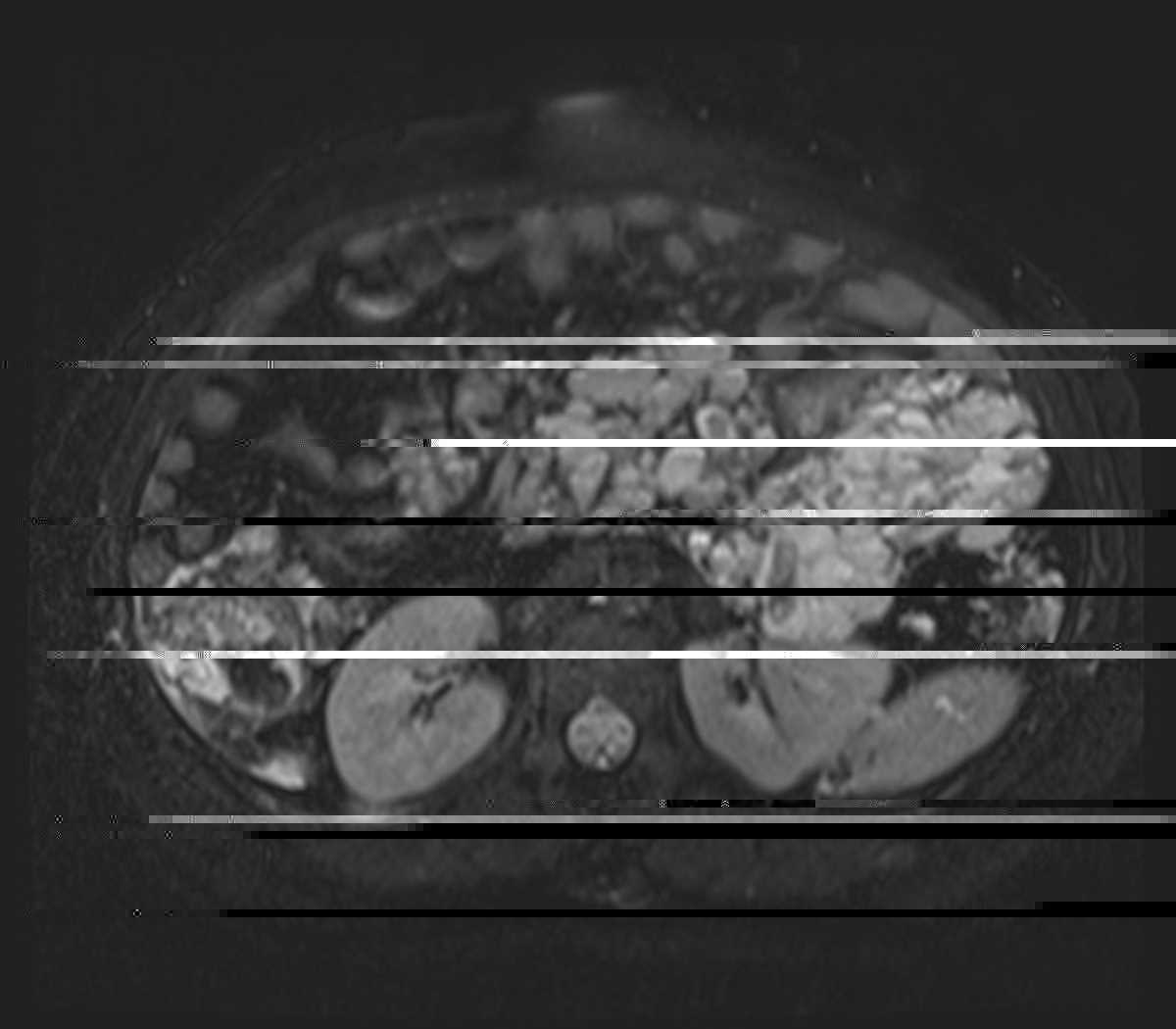 Klippel-Trenaunay-Weber Syndrome - CTisus CT Scan