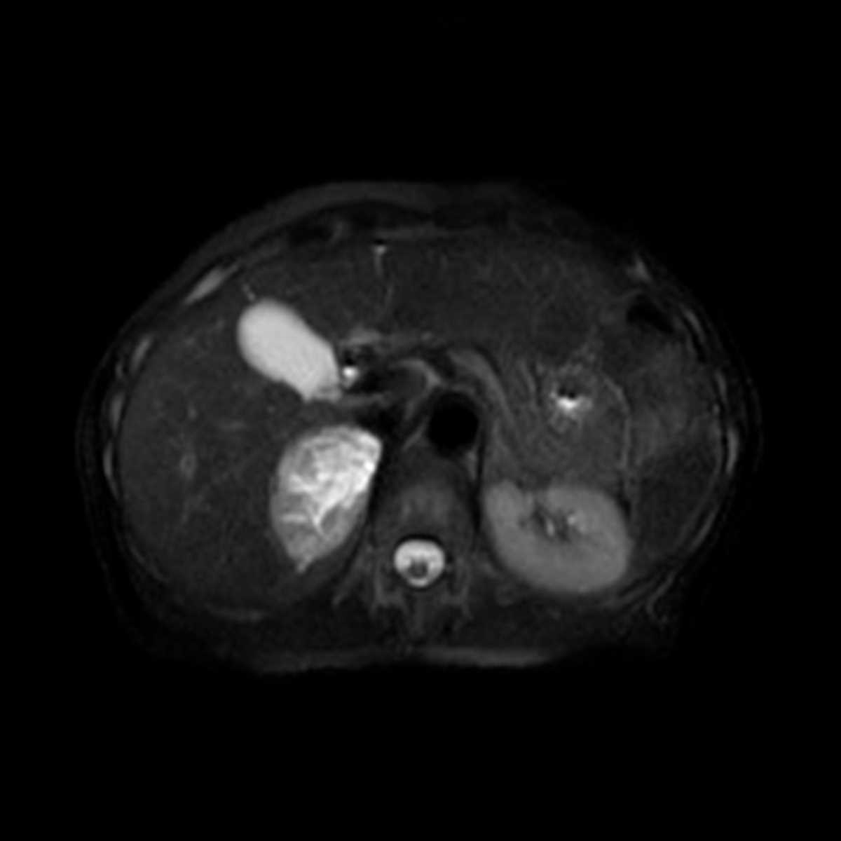 Pheochromocytoma - Body MR Case Studies - CTisus CT Scanning