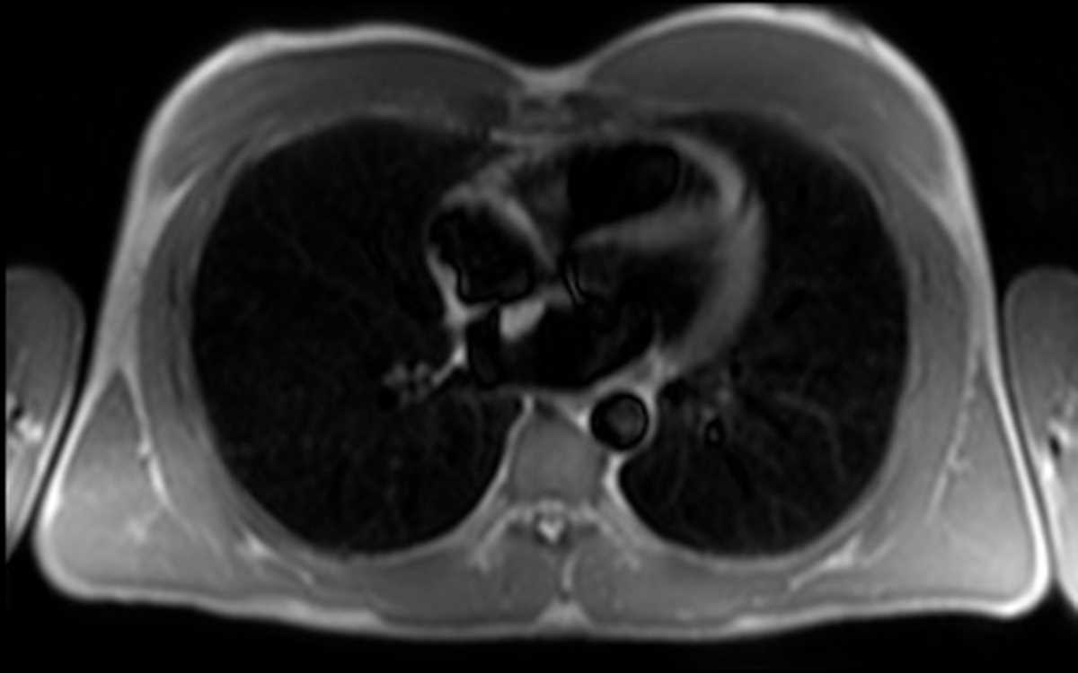 Small left atrial myxoma - CTisus CT Scan