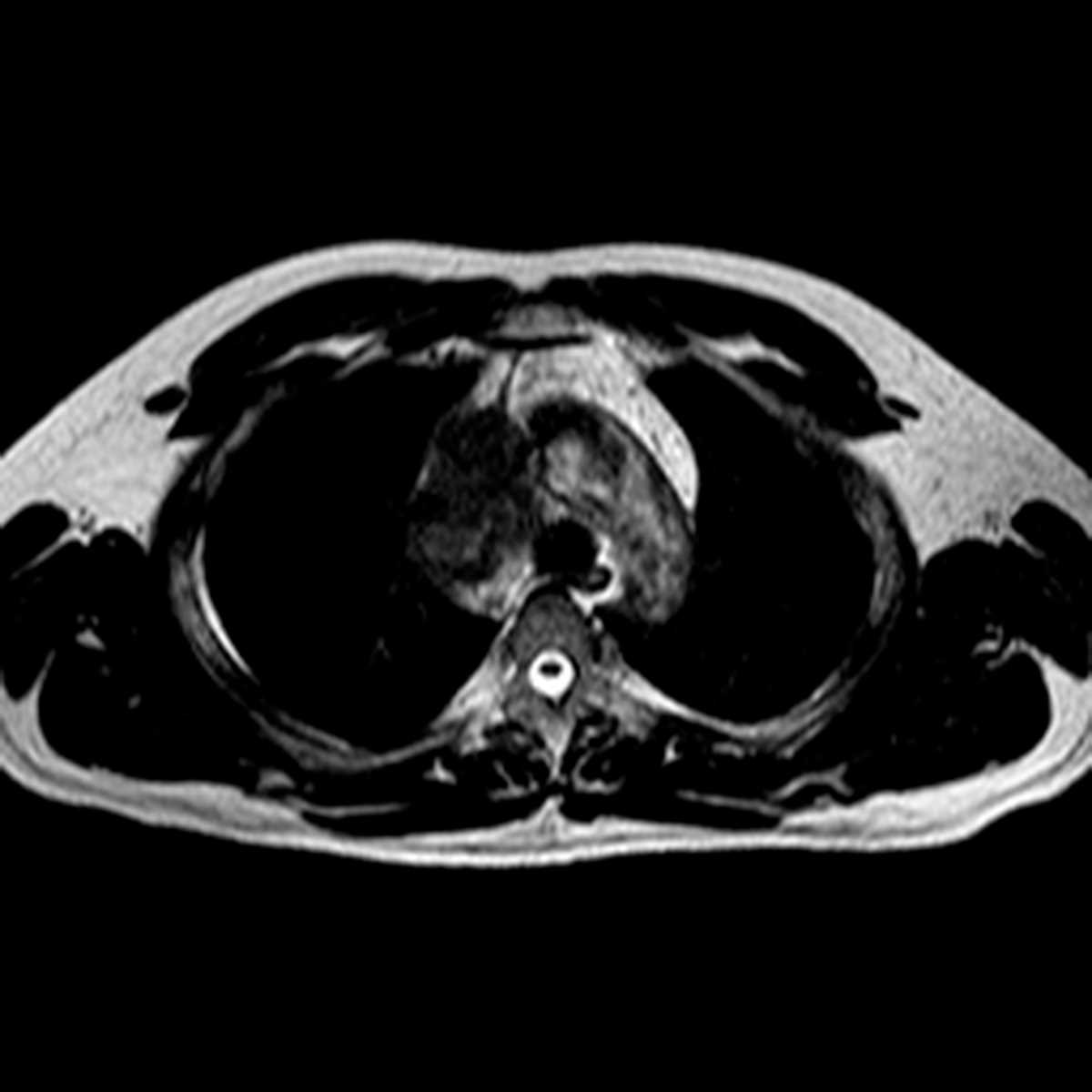 Thymoma - CTisus CT Scan