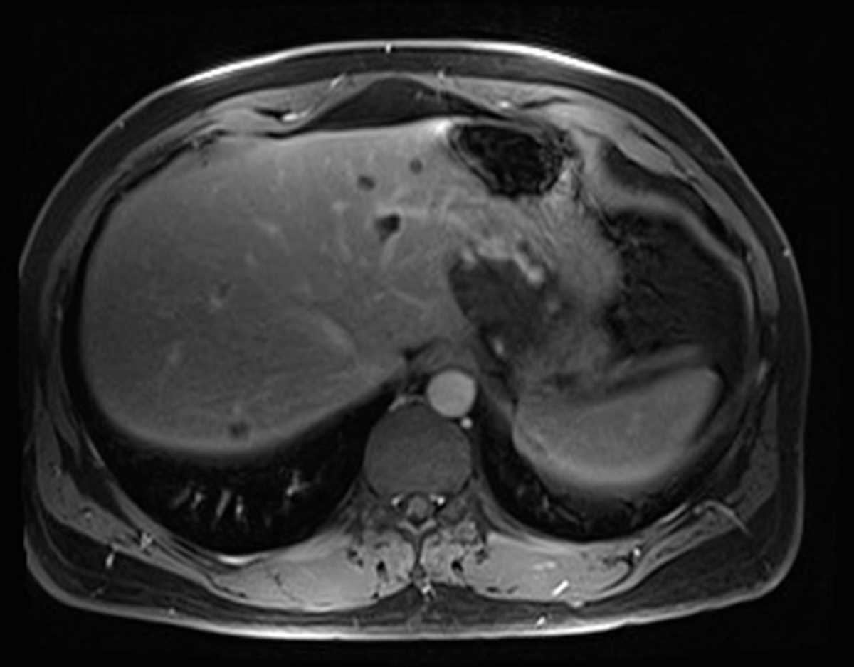 Exophytic hepatic hemangioma - CTisus CT Scan