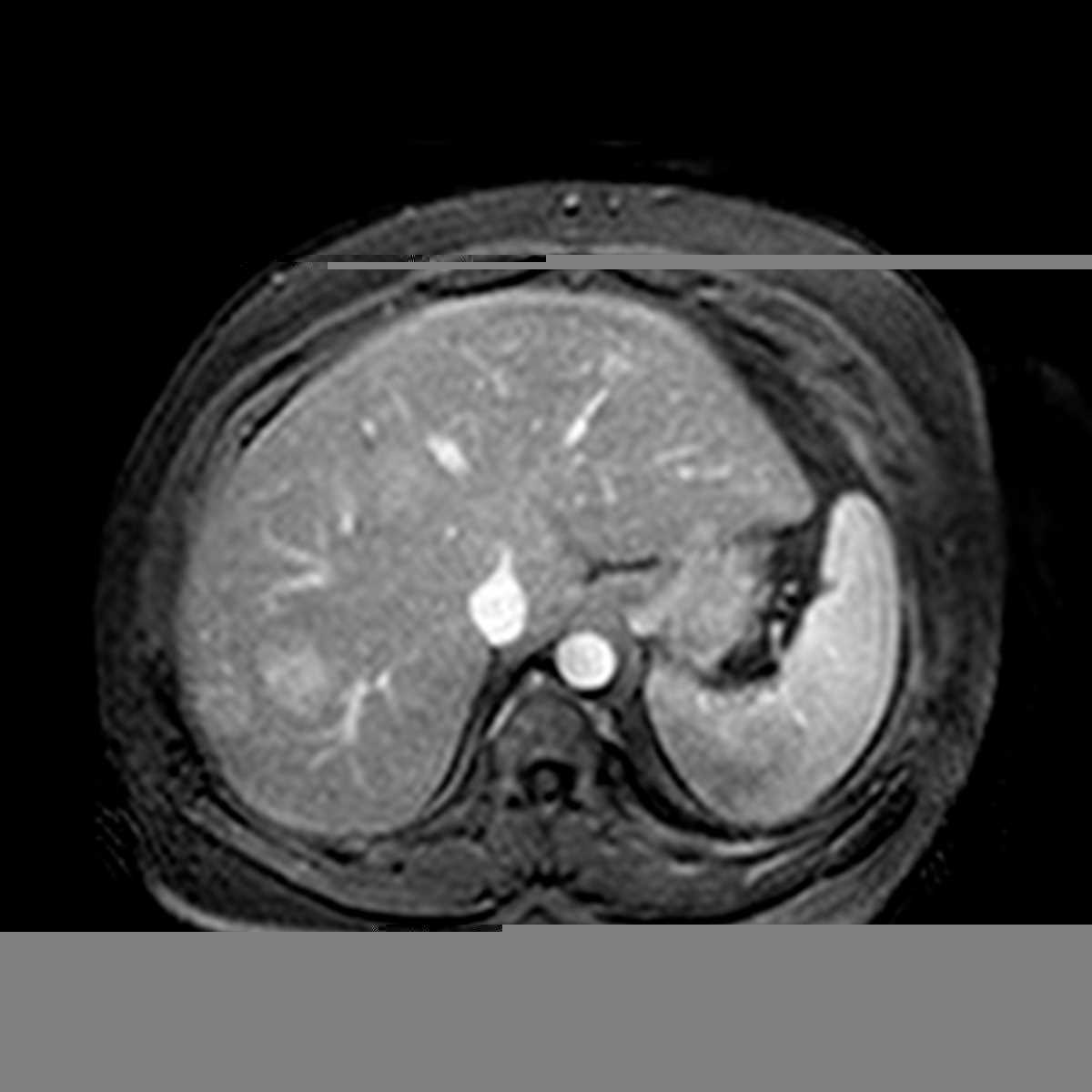 Steatotic liver with multifocal mass-like sparing - CTisus CT Scan